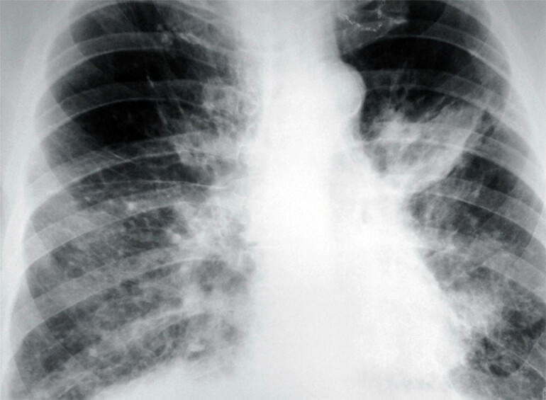 pulmonary disease